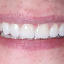 T-dent