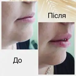 Івадерм